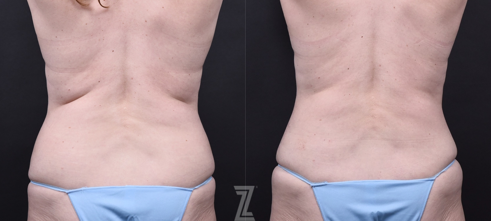 Austin Tummy Tuck Before & After Gallery - Patient 202557 - Image 6 - The Piazza Center