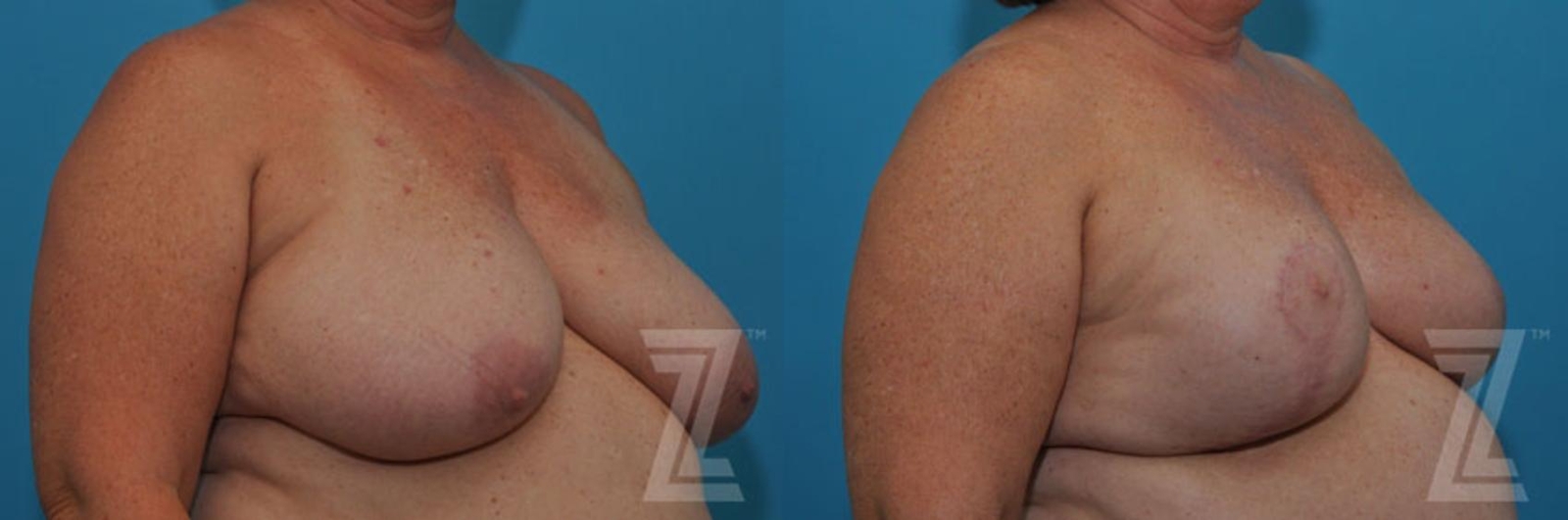 Austin Breast Reduction Before & After Gallery - Patient 132886617 - Image 4 - The Piazza Center