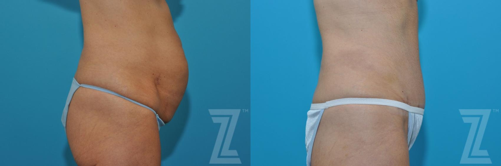 Austin Tummy Tuck Before & After Gallery - Patient 132886871 - Image 4 - The Piazza Center