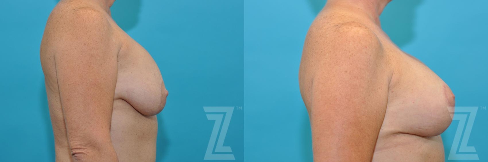 Austin Breast Augmentation Revision Before & After Gallery - Patient 132886540 - Image 5 - The Piazza Center