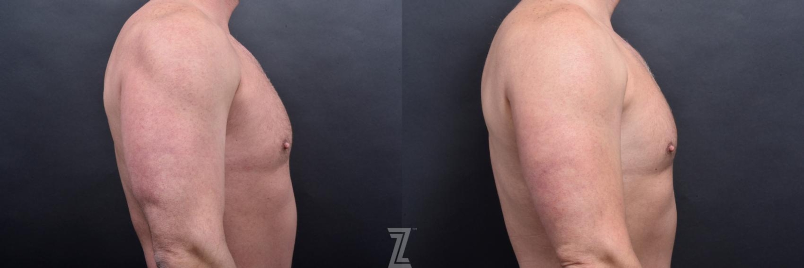 Austin Male Body Contouring Before & After Gallery - Patient 173307 - Image 7 - The Piazza Center