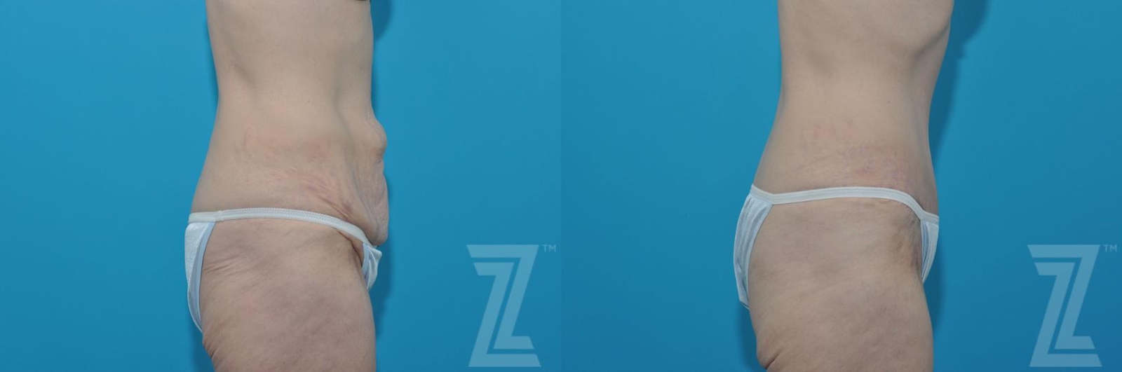 Austin Tummy Tuck Before & After Gallery - Patient 132886817 - Image 4 - The Piazza Center