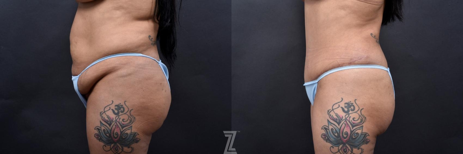 Austin Lateral Abdomen View 6 Month Post-OP Mommy Makeover in Austin, TX by Dr. Rocco Piazza - The Piazza Center