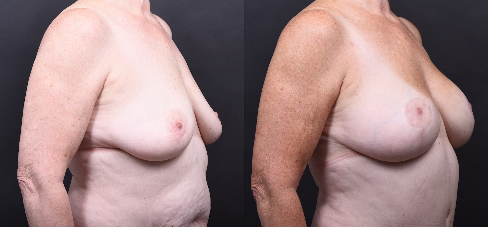 Austin Breast Augmentation With a Breast Lift Before & After Gallery - Patient 438571 - Image 2 - The Piazza Center