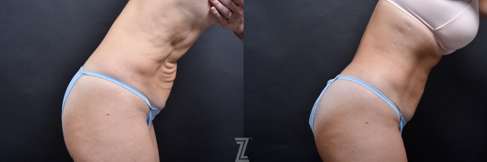 Austin Skin Pinch Before & After Gallery - Patient 132886939 - Image 5 - The Piazza Center