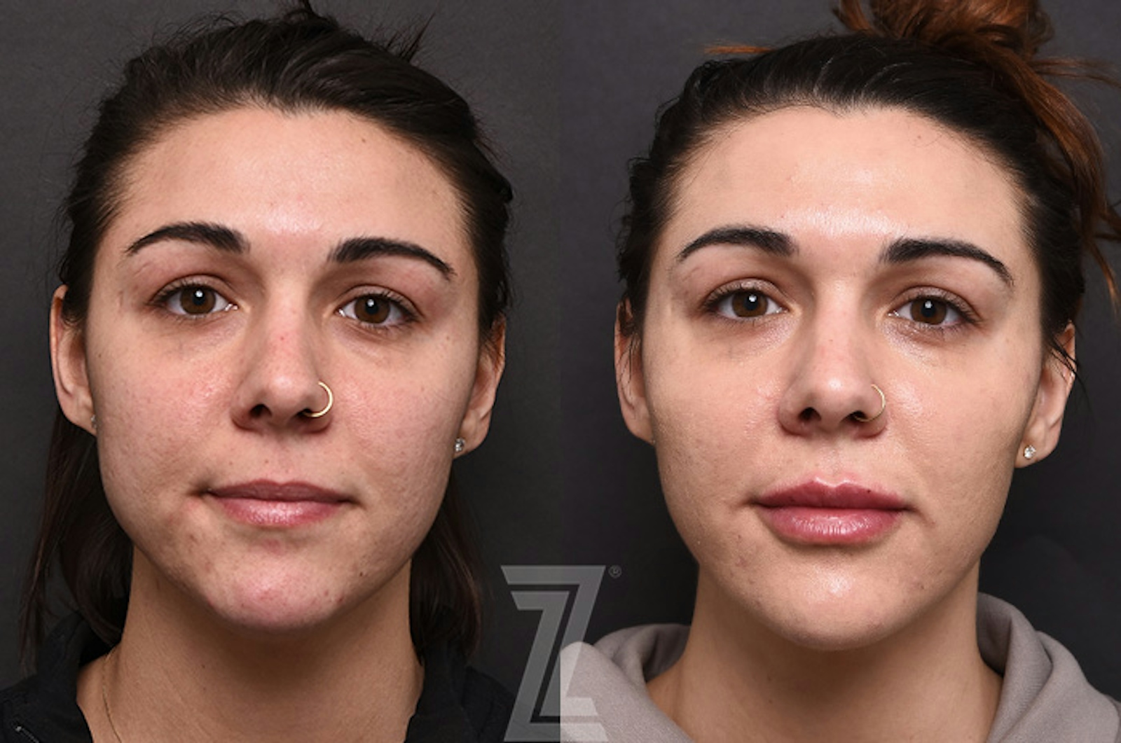 Austin Facial Rejuvenation Before & After Gallery - Patient 238339 - Image 1 - The Piazza Center