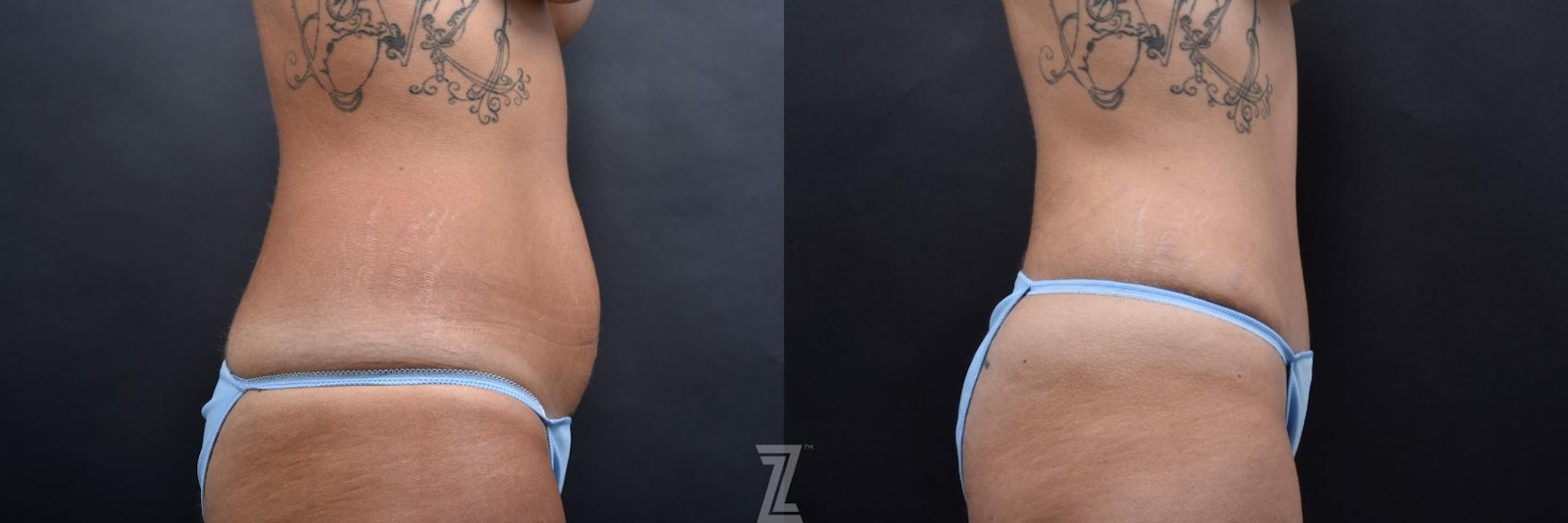 Austin Tummy Tuck Before & After Gallery - Patient 132886801 - Image 4 - The Piazza Center