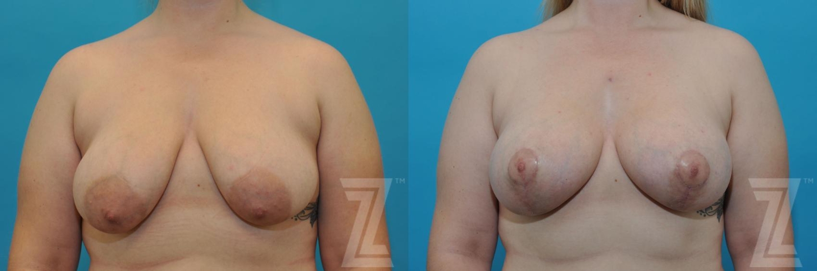 Austin Correction of Breast Asymmetry Before & After Gallery - Patient 132886777 - Image 1 - The Piazza Center