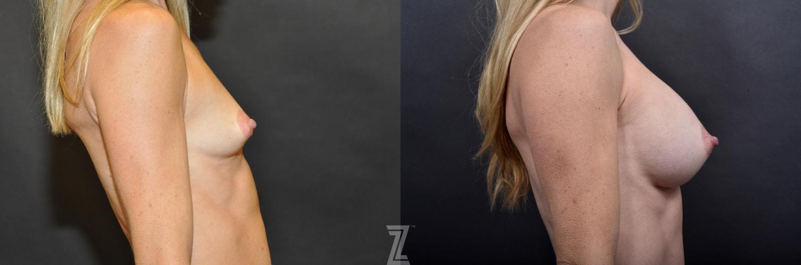 Austin Side View Before and After 4 year post op of 41 year old woman with Silicone Implants with Cohesive Silicone Gel - Dr. Rocco Piazza - The Piazza Center