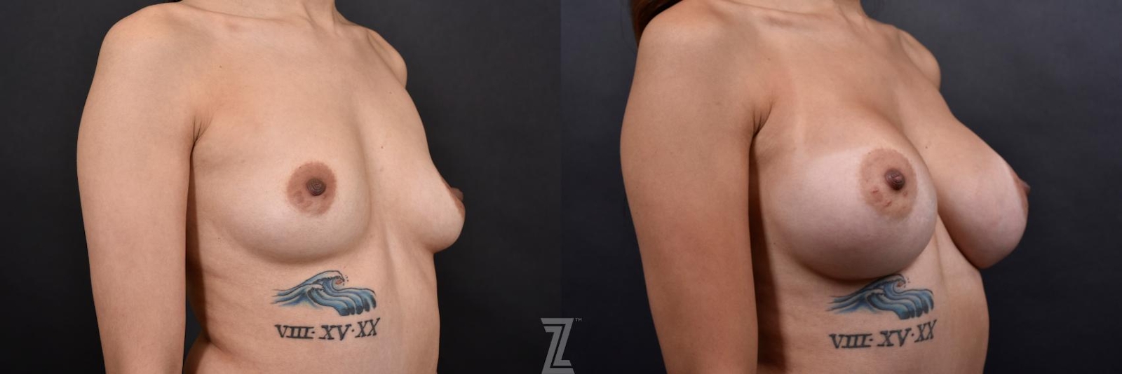 Austin 32 year old woman before and after oblique view with Silicone Implants with Cohesive Silicone Gel - The Piazza Center - The Piazza Center