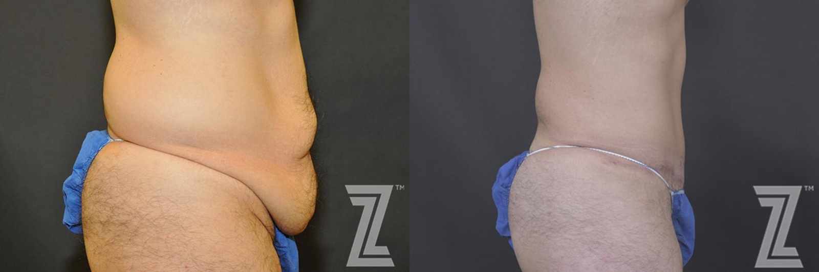 Austin Tummy Tuck Before & After Gallery - Patient 132886870 - Image 6 - The Piazza Center