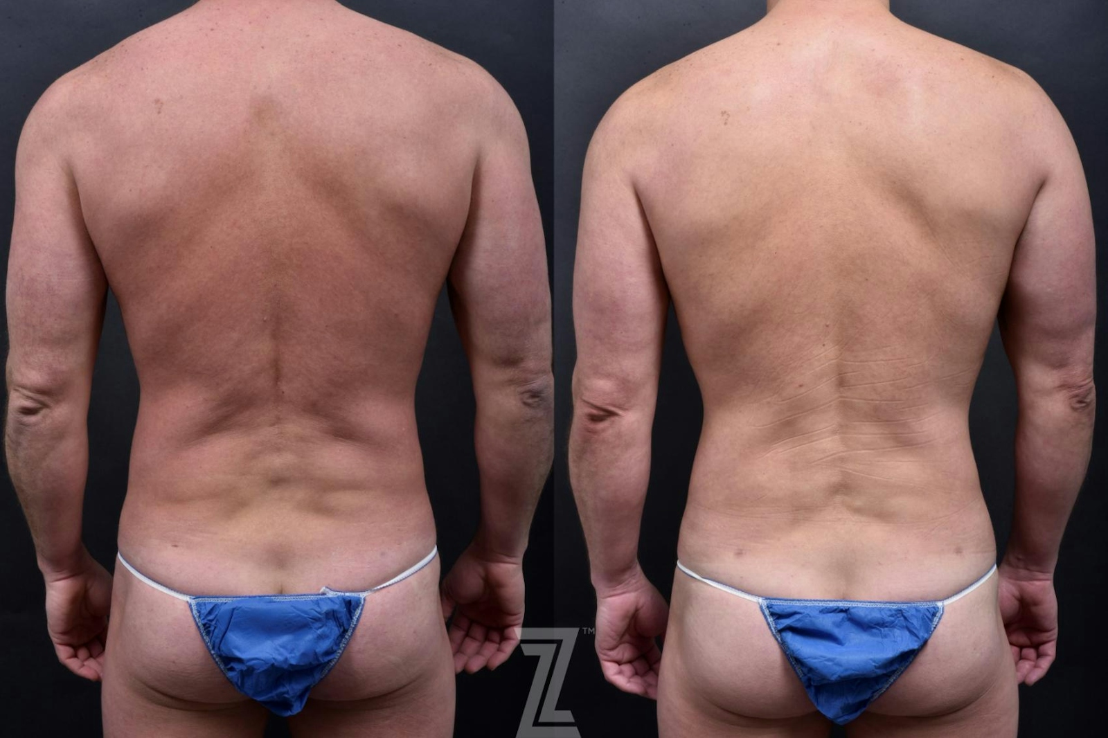 Austin Male Body Contouring Before & After Gallery - Patient 173307 - Image 2 - The Piazza Center