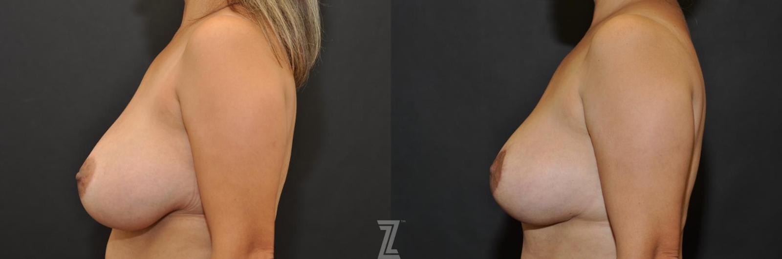 Austin Breast Lift Before & After Gallery - Patient 132791061 - Image 3 - The Piazza Center