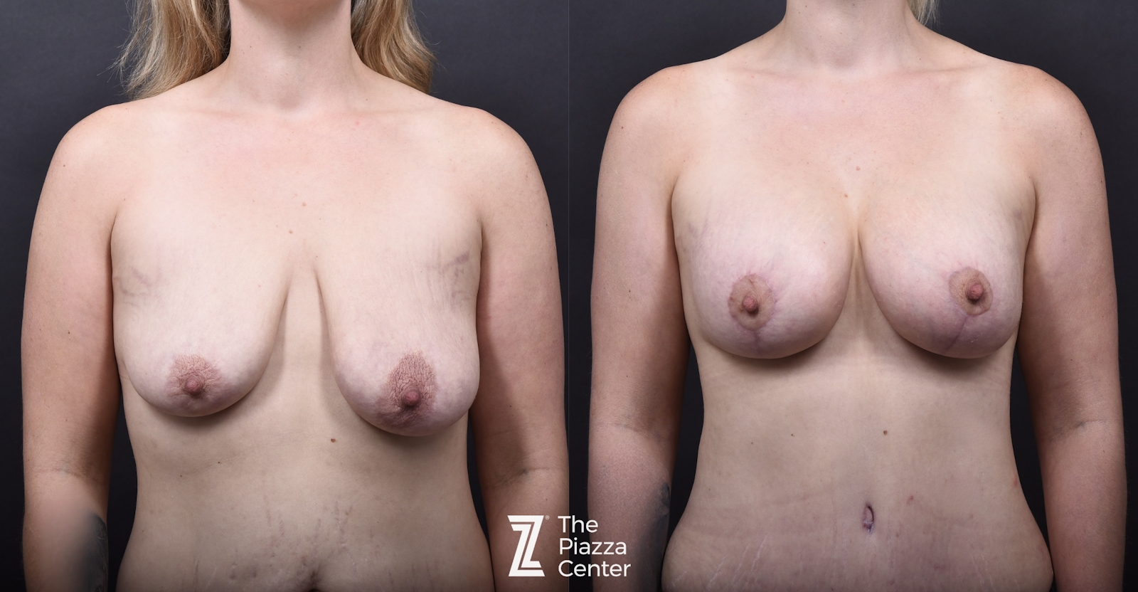 Austin Motiva Implants Before & After Gallery - Patient 417332 - Image 1 - The Piazza Center