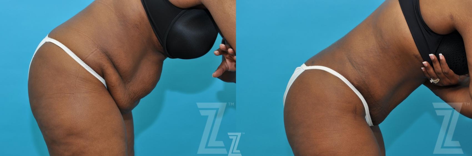 Austin Tummy Tuck Before & After Gallery - Patient 117774 - Image 5 - The Piazza Center