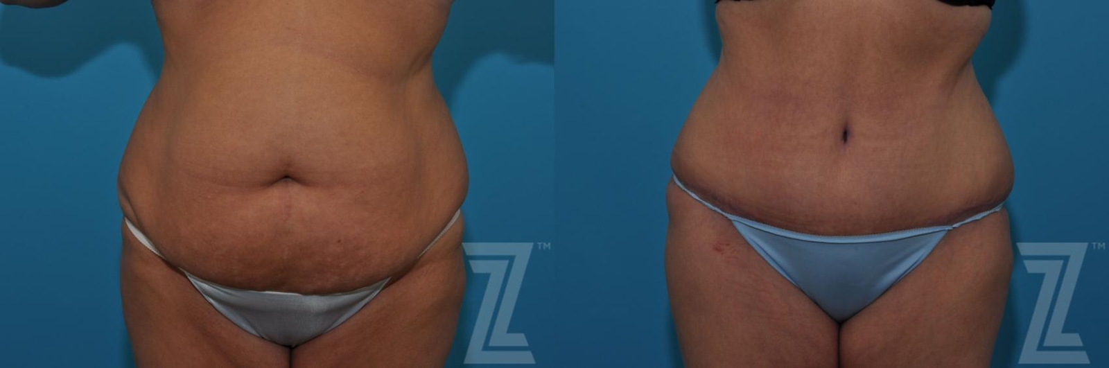 Austin Tummy Tuck Before & After Gallery - Patient 132886809 - Image 1 - The Piazza Center