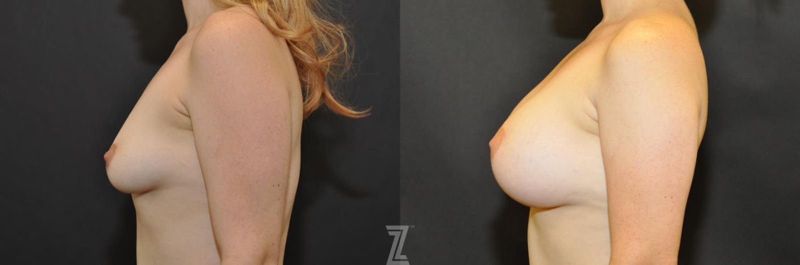 Austin Lateral view before & after images of 28 year old woman 2 year post op with Silicone Implants with Cohesive Silicone Gel - The Piazza Center - The Piazza Center