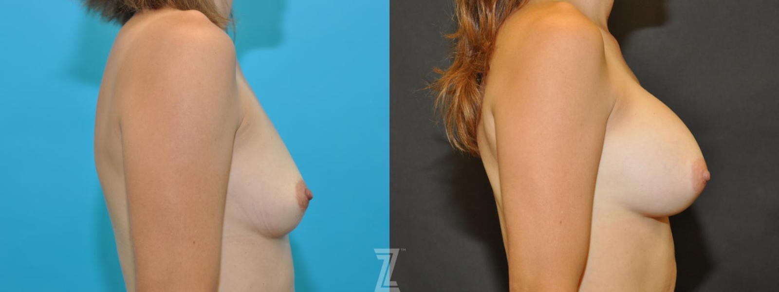 Austin Lateral view before & after images of 38-year-old active mother of three with Silicone Implants with Highly Cohesive Gel (Gummy Bear Implants) - The Piazza Center - The Piazza Center