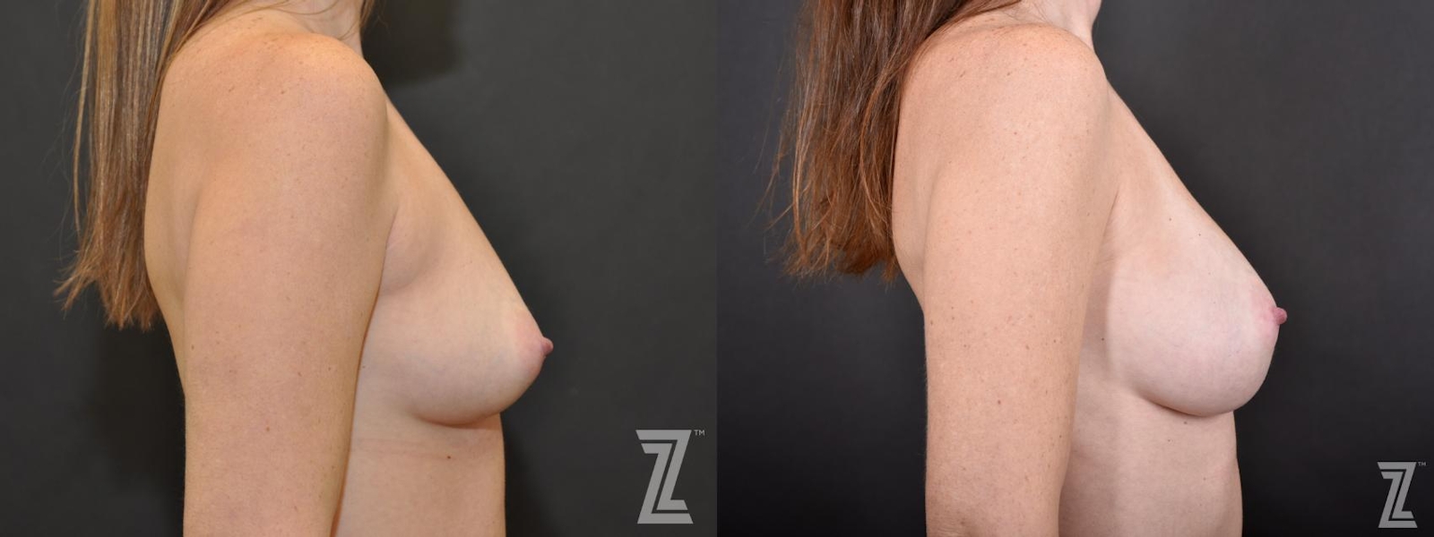 Austin Side View of before and after 33 year old women with Silicone Implants with Cohesive Silicone Gel at the Piazza center - The Piazza Center