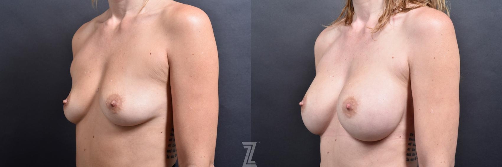 Austin oblique View before and after 1 year post op 39 year old woman with Silicone Implants with Cohesive Silicone Gel - The Piazza Center