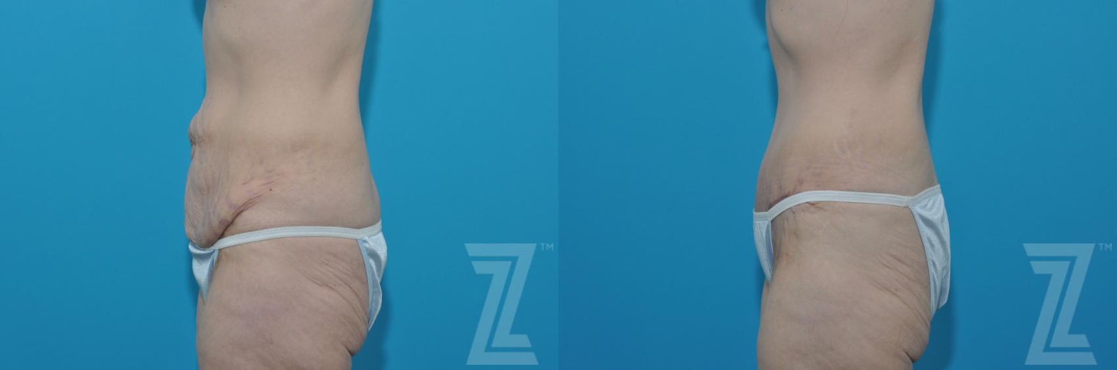 Austin Tummy Tuck Before & After Gallery - Patient 132886817 - Image 2 - The Piazza Center
