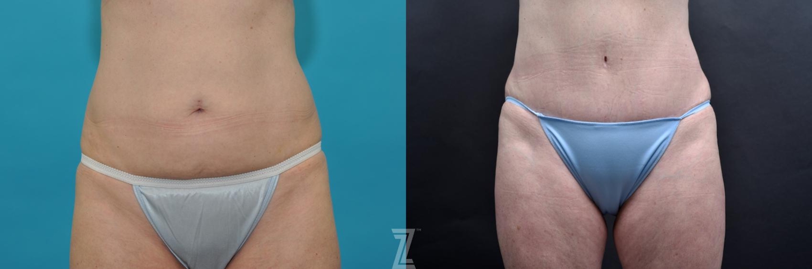 Austin Frontal abdominal view 7 year post op mommy makeover - The Piazza Center, Austin Tx - The Piazza Center