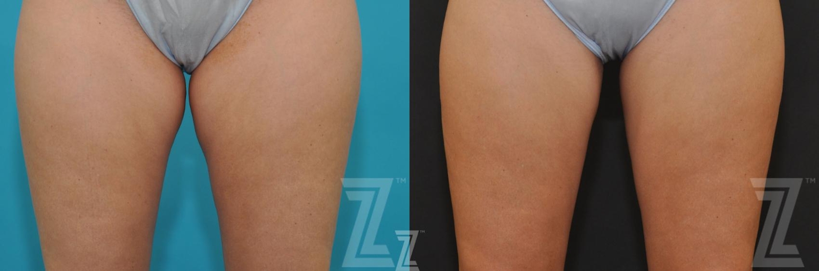 Austin CoolSculpting® Before & After Gallery - Patient 132905396 - Image 1 - The Piazza Center