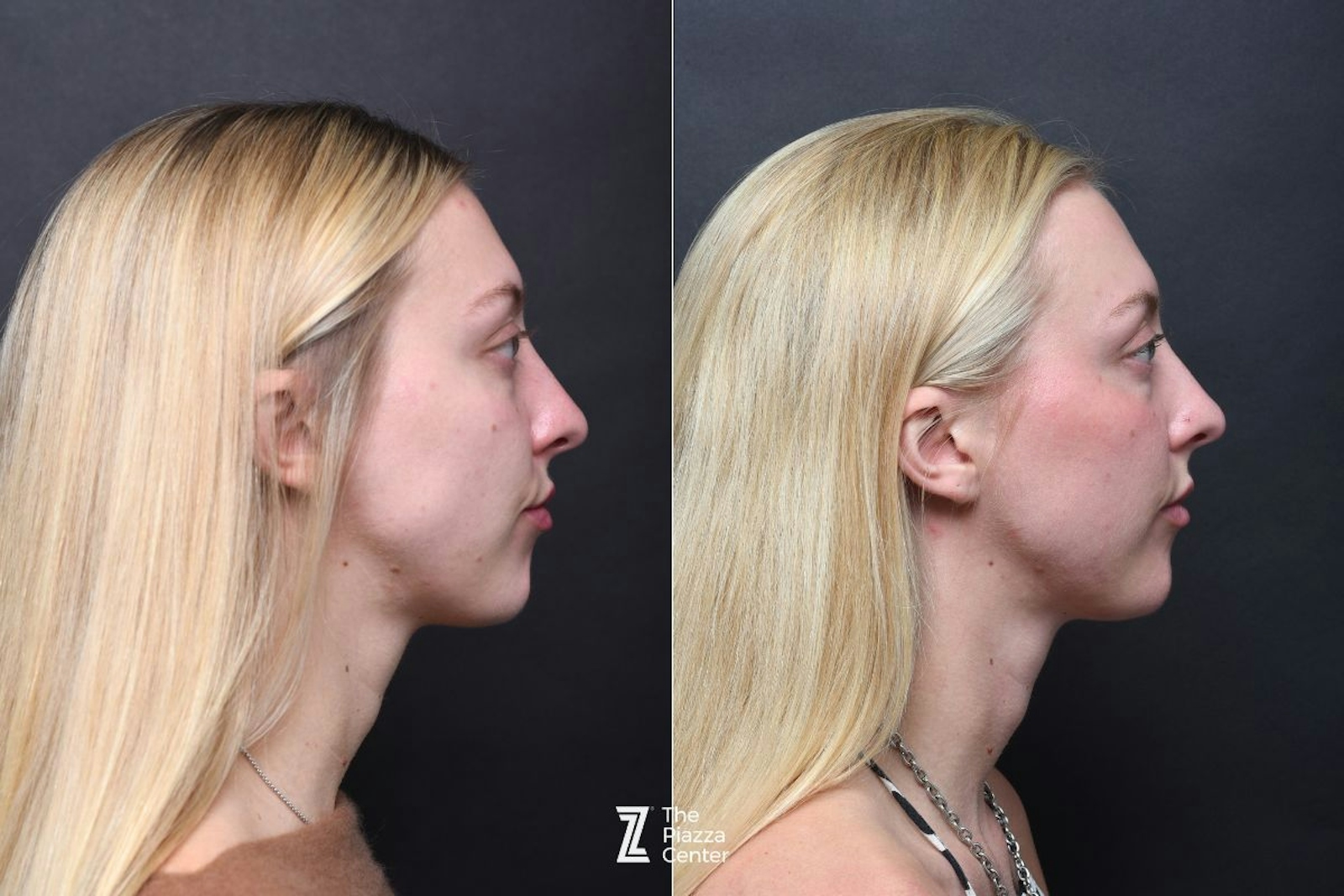Austin Facial Rejuvenation Before & After Gallery - Patient 229953 - Image 4 - The Piazza Center