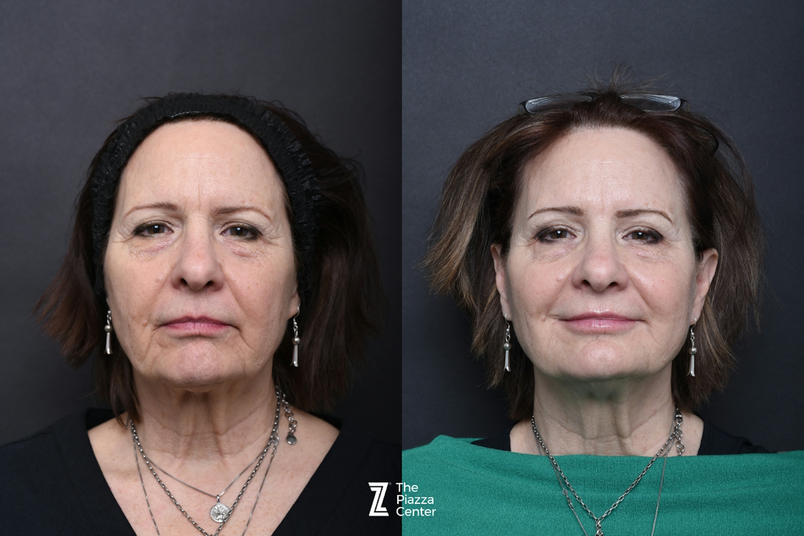Austin Facial Rejuvenation Before & After Gallery - Patient 999542 - Image 1 - The Piazza Center