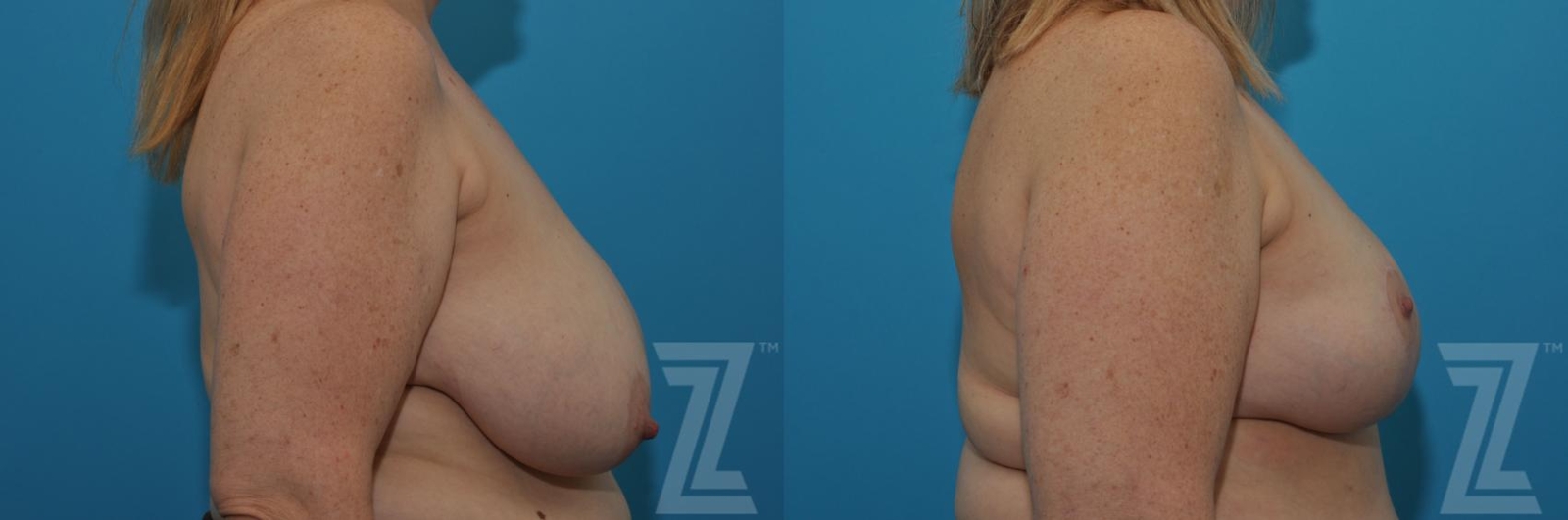 Austin Breast Reduction Before & After Gallery - Patient 132886750 - Image 3 - The Piazza Center