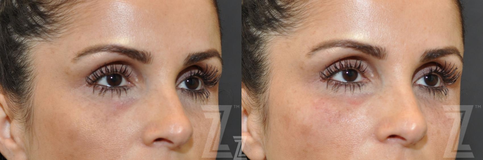Austin Injectable Fillers Before & After Gallery - Patient 132963099 - Image 2 - The Piazza Center