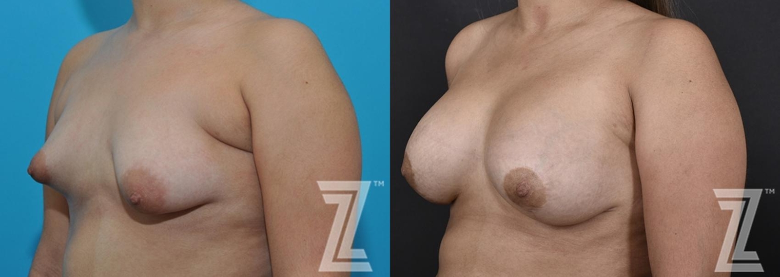 Austin Correction of Breast Asymmetry Before & After Gallery - Patient 132886781 - Image 2 - The Piazza Center