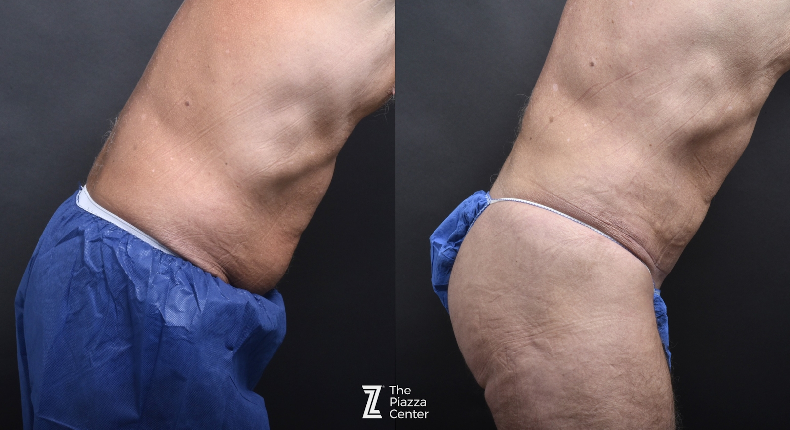 Austin Skin Pinch Before & After Gallery - Patient 283397 - Image 2 - The Piazza Center