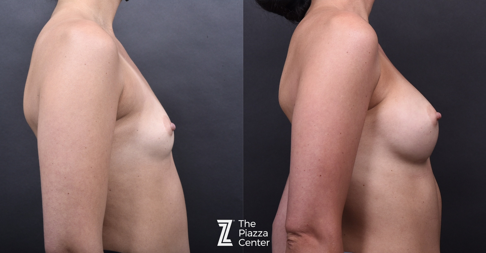 Austin Breast Augmentation Before & After Gallery - Patient 790705 - Image 3 - The Piazza Center