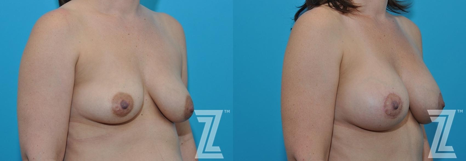 Austin before & after oblique view of breasts 3 month post op 39 year old woman mommy make over - The Piazza Center, Austin TX - The Piazza Center