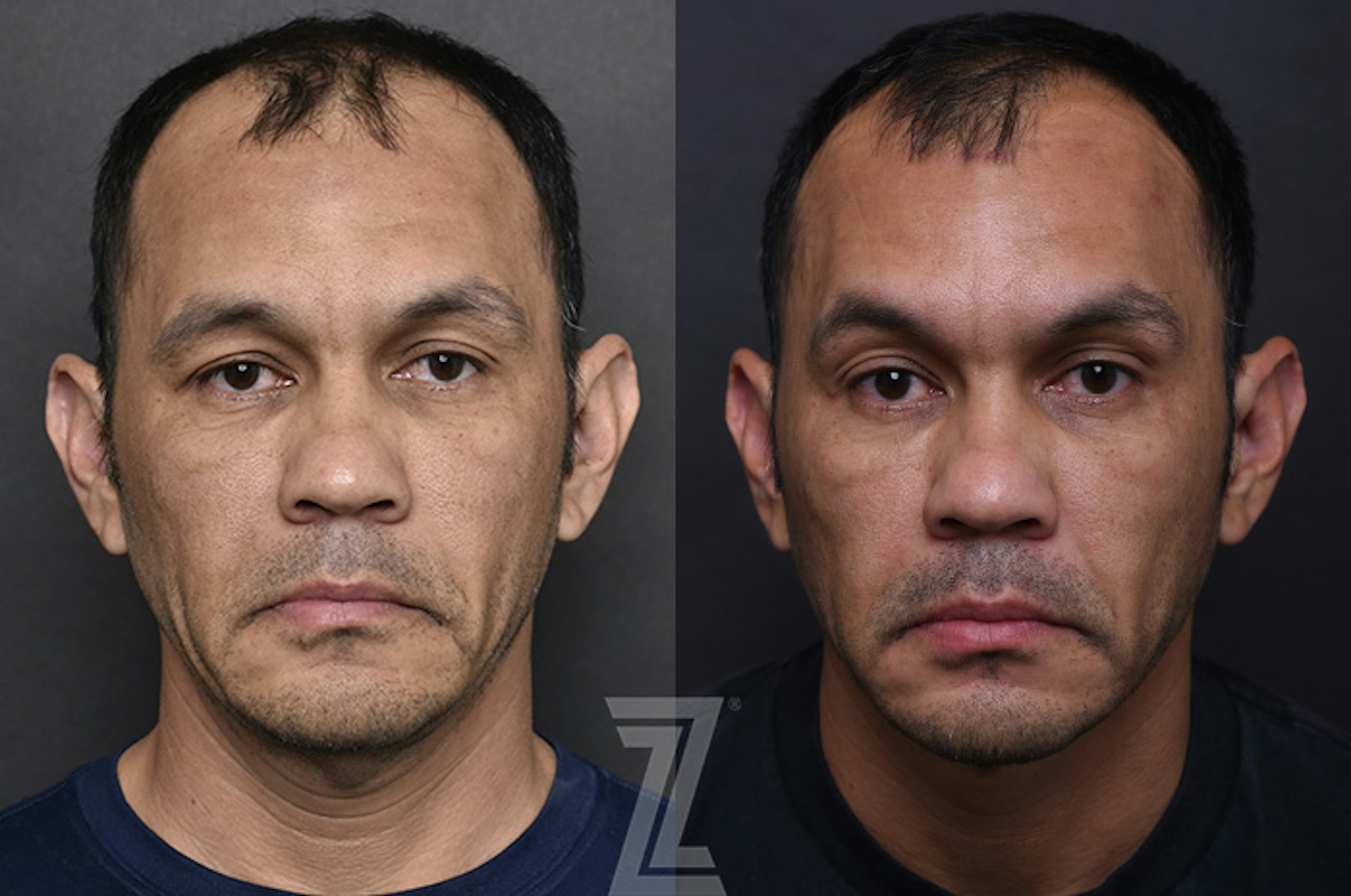 Austin Male Injectables Before & After Gallery - Patient 325552 - Image 1 - The Piazza Center