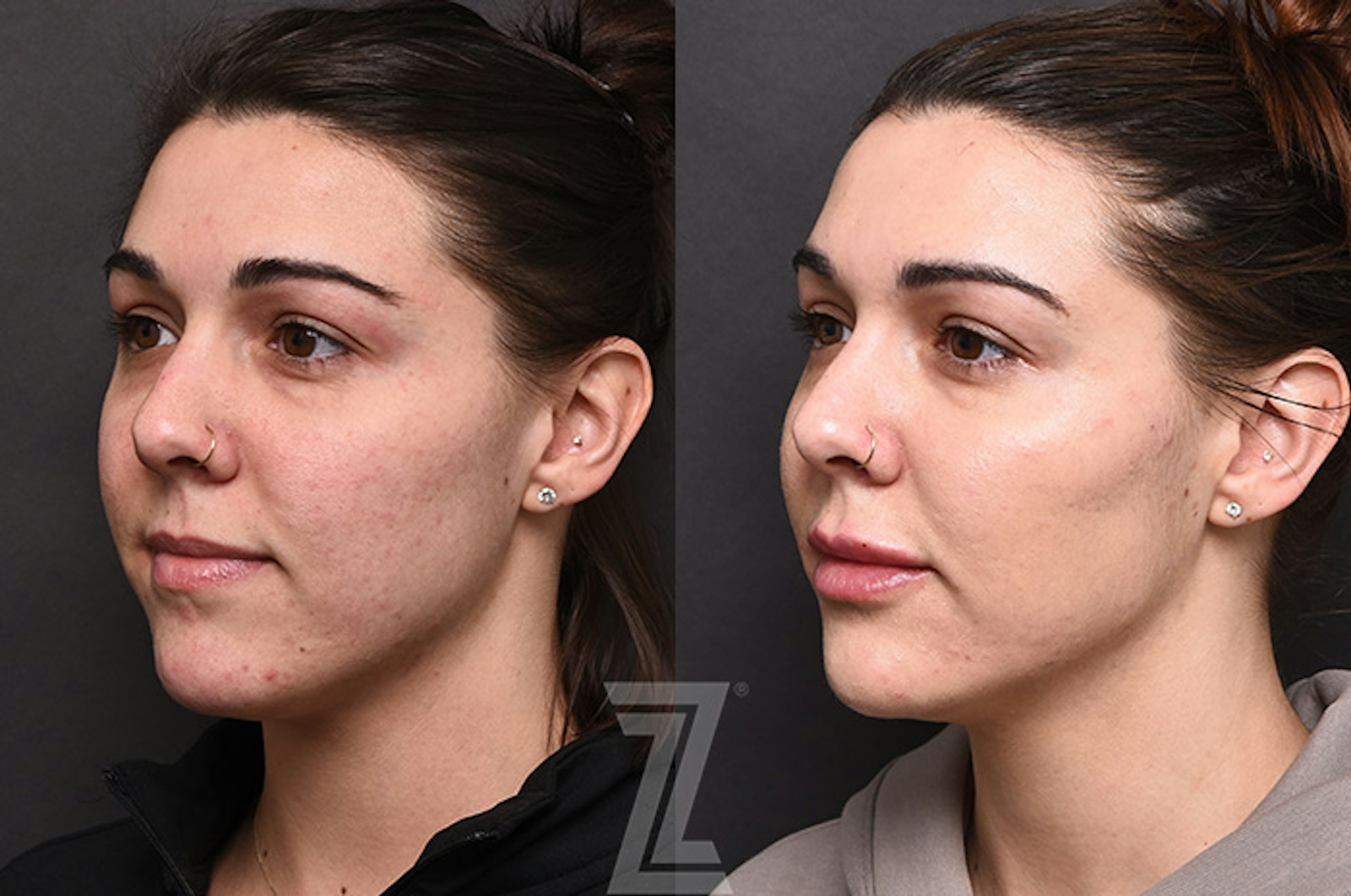 Austin Facial Rejuvenation Before & After Gallery - Patient 238339 - Image 4 - The Piazza Center