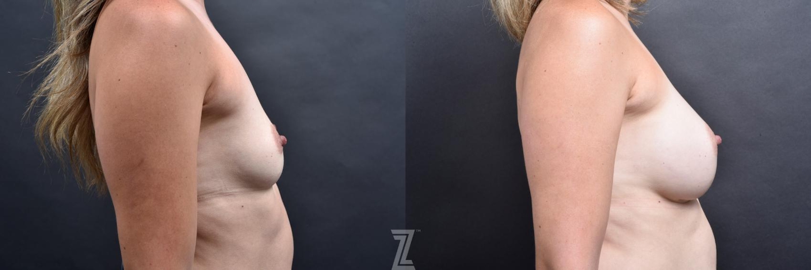 Austin before and after lateral view of 35 year old woman with Silicone Implants with Cohesive Silicone Gel - The Piazza Center - The Piazza Center