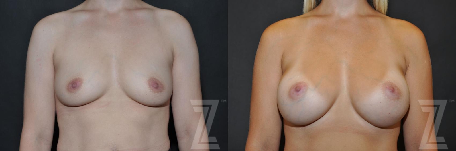 Austin 6 Months After Breast Augmentation in Austin, TX Before & After by Dr. Rocco Piazza - The Piazza Center