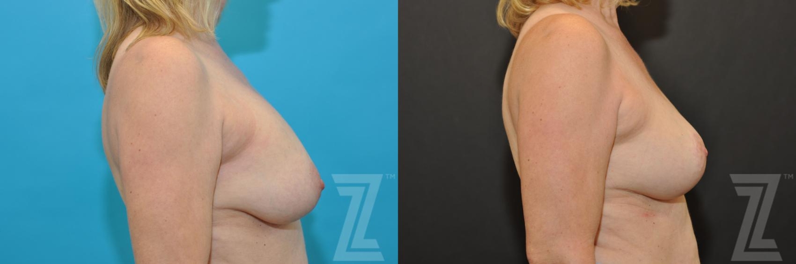 Austin Breast Augmentation Revision Before & After Gallery - Patient 132793346 - Image 5 - The Piazza Center
