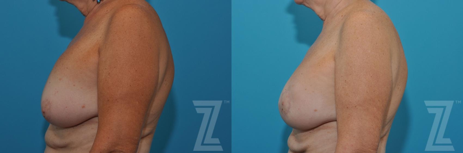 Austin Breast Augmentation Revision Before & After Gallery - Patient 132886586 - Image 3 - The Piazza Center