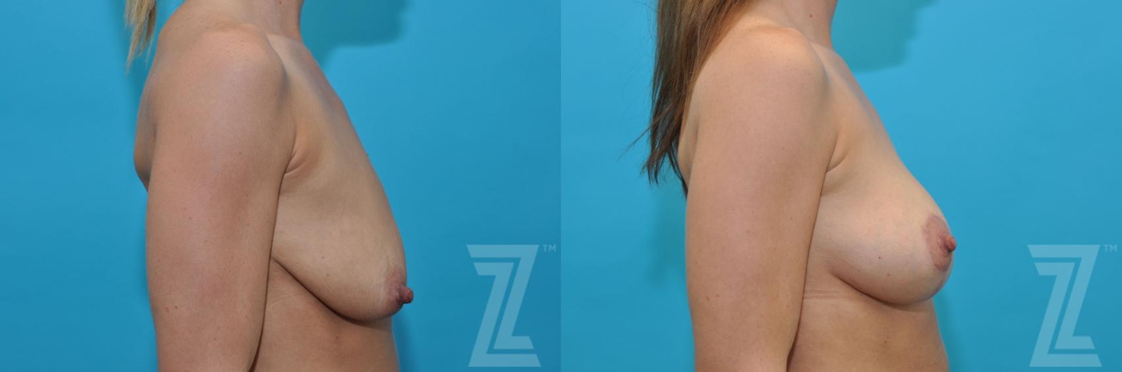 Austin Breast Augmentation With a Breast Lift Before & After Gallery - Patient 132791091 - Image 5 - The Piazza Center