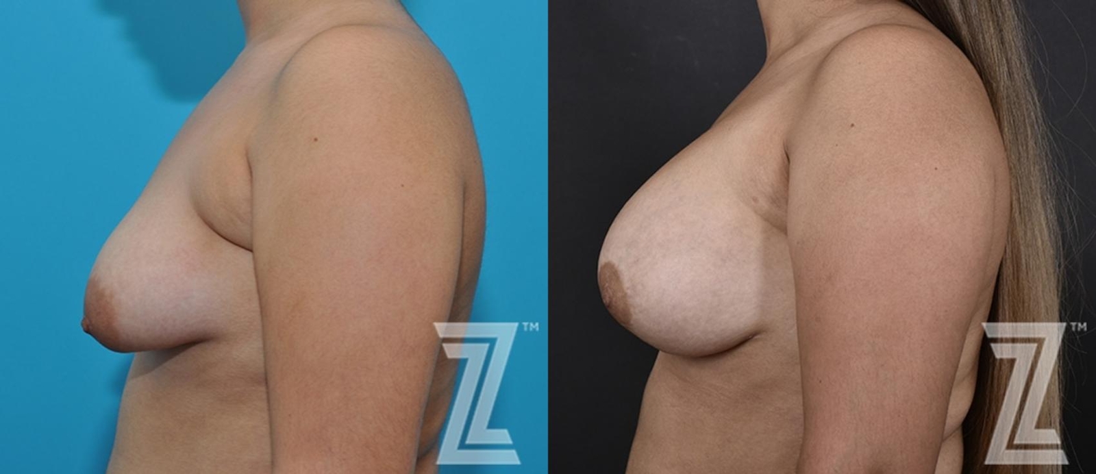 Austin Correction of Breast Asymmetry Before & After Gallery - Patient 132886781 - Image 3 - The Piazza Center