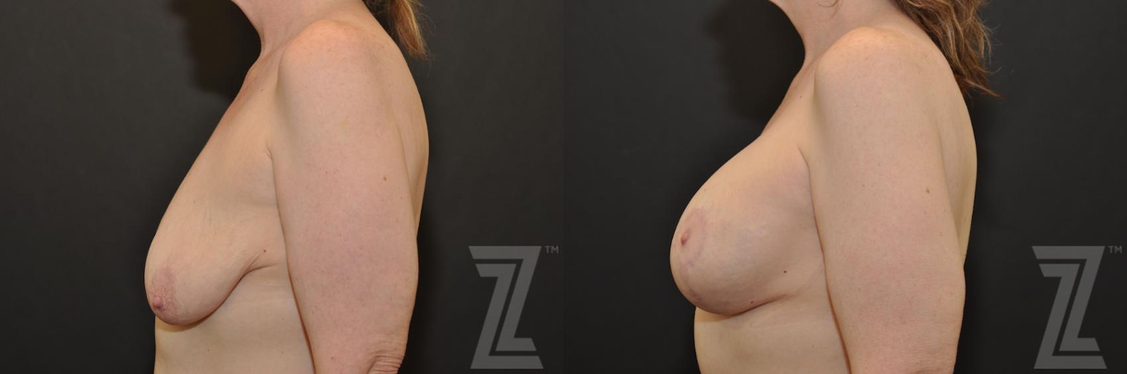Austin Breast Augmentation With a Breast Lift Before & After Gallery - Patient 132793338 - Image 3 - The Piazza Center