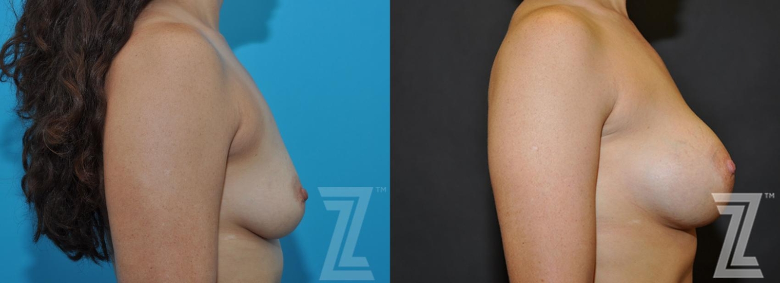 Austin Side View before & after images of 33 year old woman with breast augmentation - The Piazza Center - The Piazza Center
