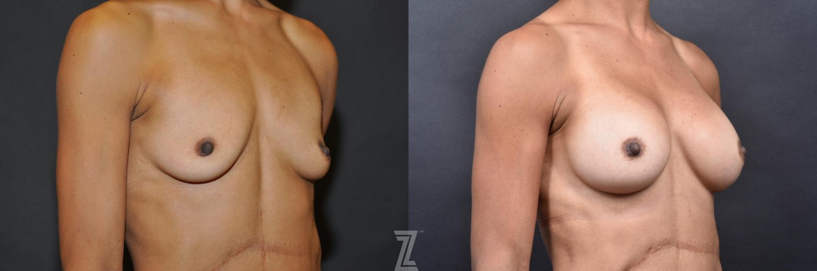Austin Oblique view before & after images of 35-year-old mother with breat augmentation - Dr. Rocco Piazza - The Piazza Center