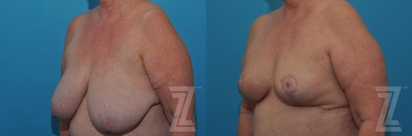 Austin Breast Reduction Before & After Gallery - Patient 132886611 - Image 2 - The Piazza Center