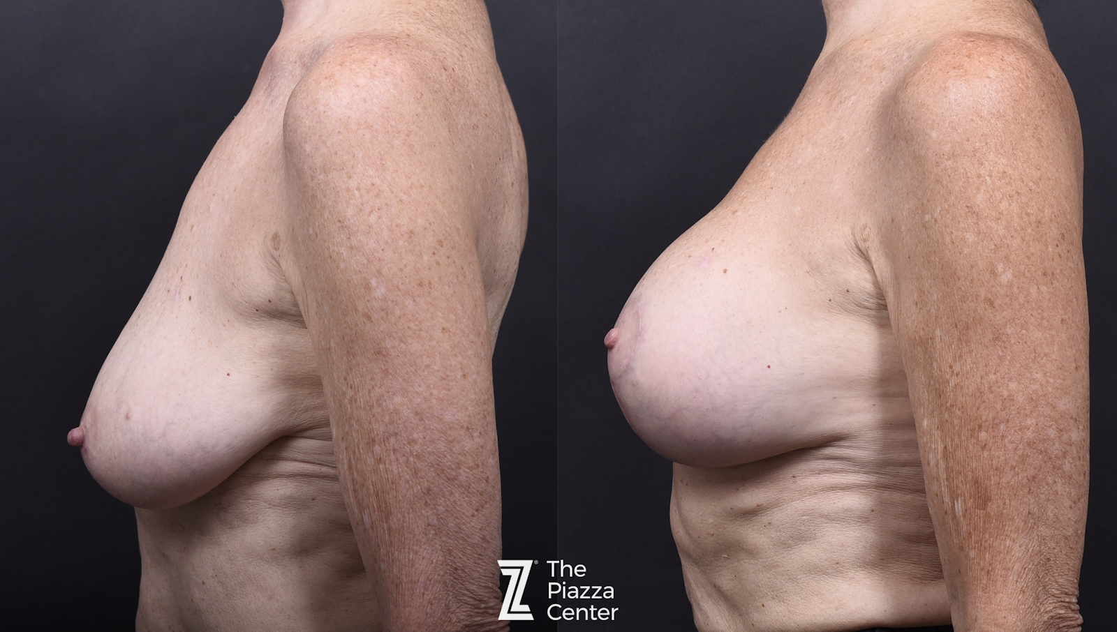 Austin Breast Augmentation Before & After Gallery - Patient 287263 - Image 5 - The Piazza Center