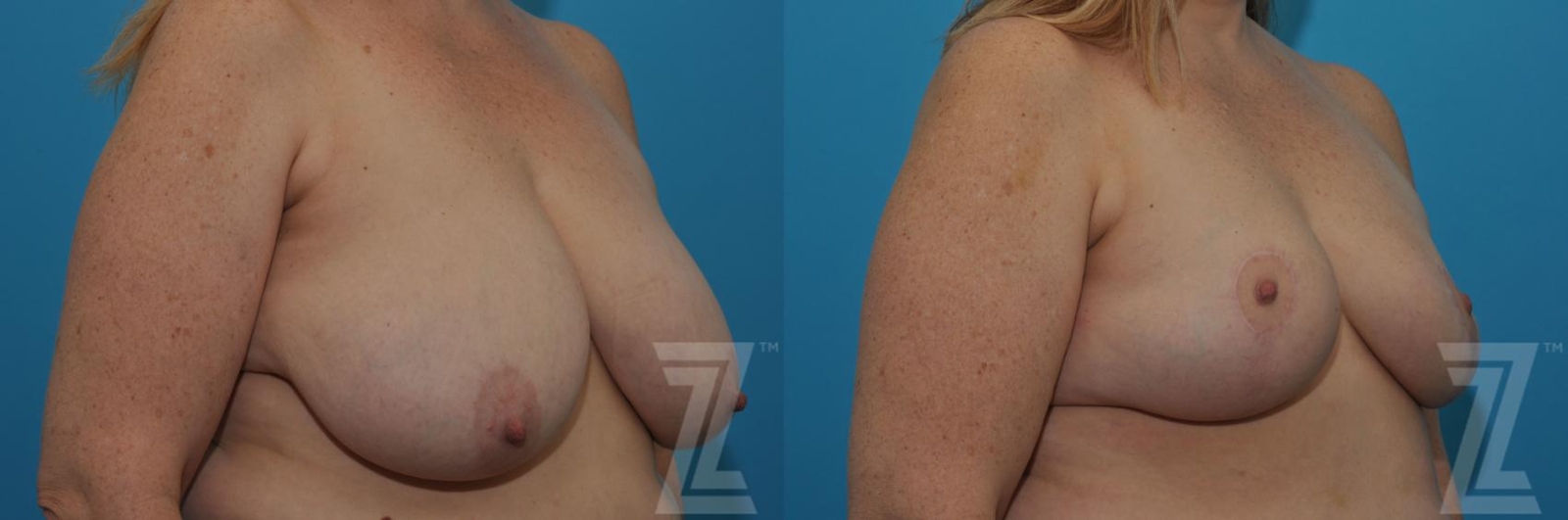 Austin Breast Reduction Before & After Gallery - Patient 132886750 - Image 2 - The Piazza Center