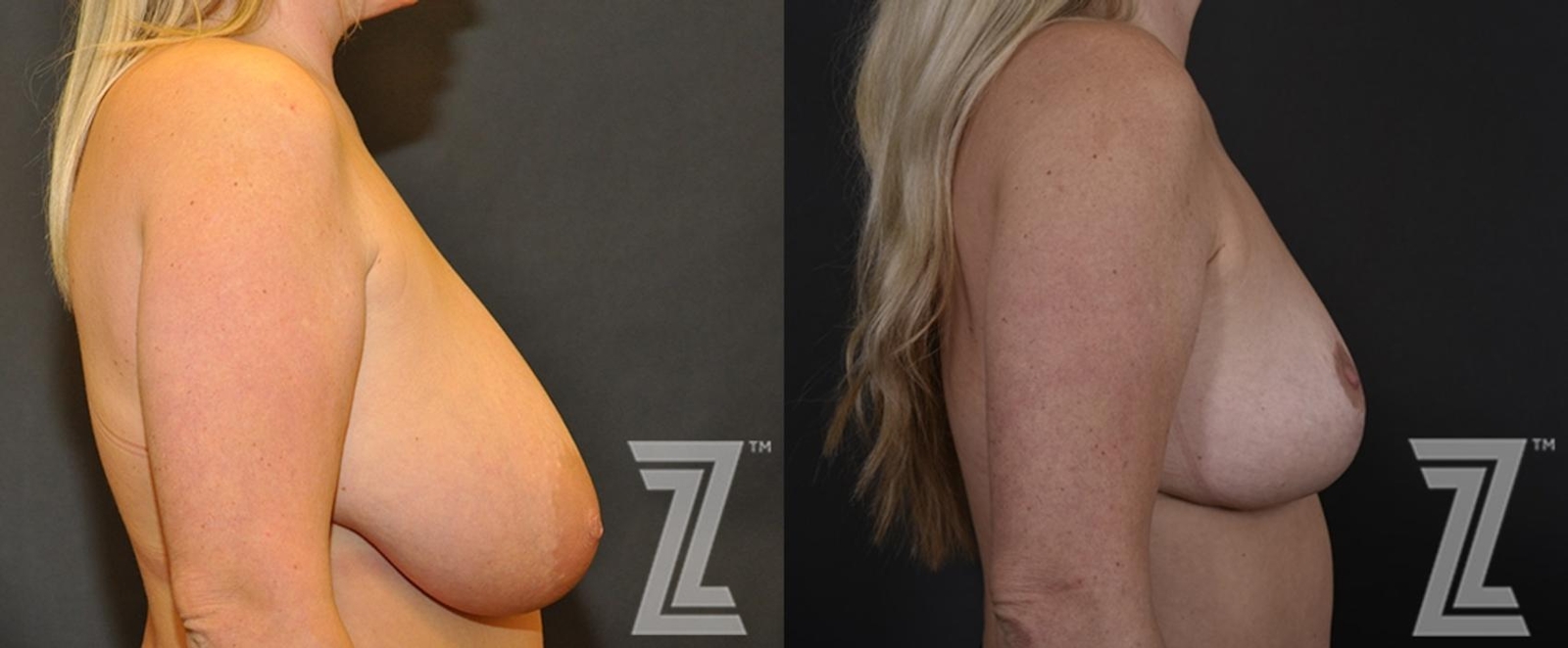 Austin Breast Reduction Before & After Gallery - Patient 132886746 - Image 5 - The Piazza Center